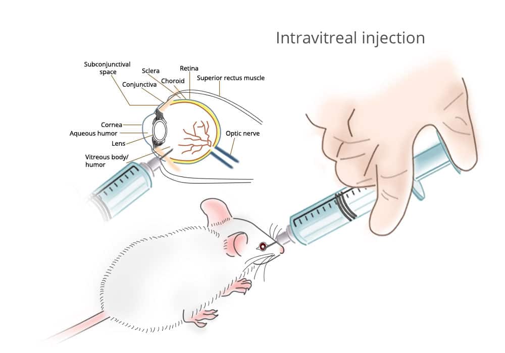 B-08-Intravitreal-injection